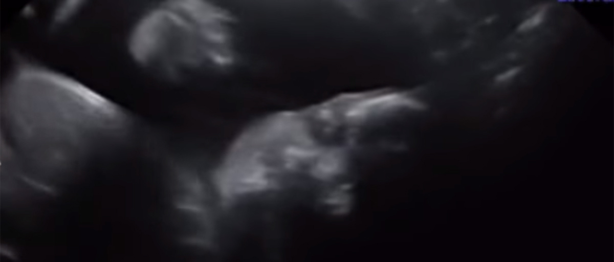 Ungeborenes überrascht Eltern beim Ultraschall