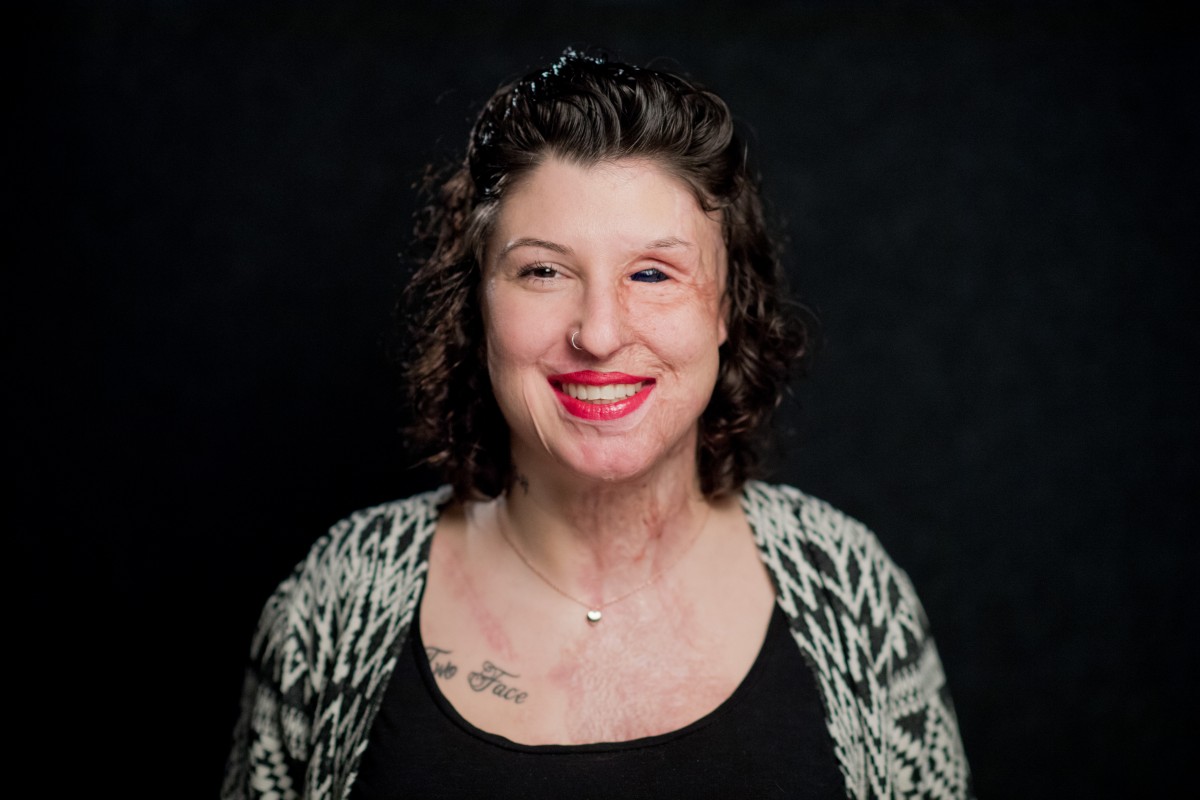 Säureopfer versteckt sich nicht: „Überlebende“ ist ihr neues Tattoo