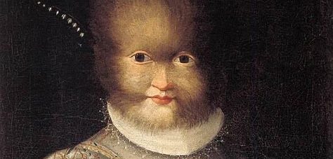 Falsches Medikament verwandelt Babys in Spanien in „Werwölfe“