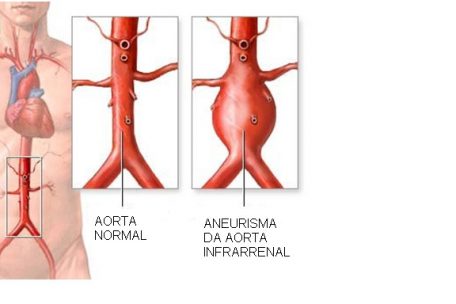 Arterien-Ausdehnung  / Bauchraum-Aneurysmen sind klein und lebensbedrohlich