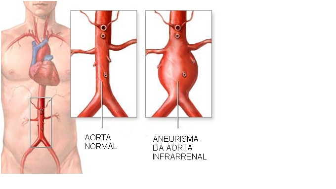 Arterien-Ausdehnung  / Bauchraum-Aneurysmen sind klein und lebensbedrohlich