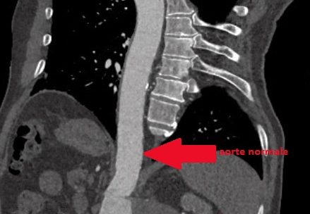 Ein Röntgenbild zeigt die Operation eines Bauchraum-Aneurysmas an der Hauptschlagader. Die Pfeile zeigen die Aorta (oben) und die krankhafte Ausdehnung des großen Blutgefäßes (unten).