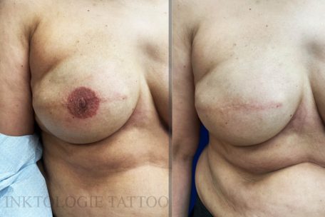 Auf die Narbe hat Biewers eine neue Mamille in 3D gestochen