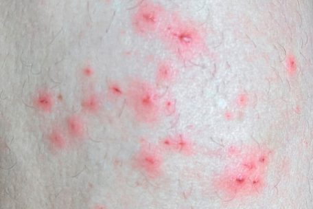 Das vom &bdquo;Institute of Tropical Medicine Antwerp&ldquo; zur Verf&uuml;gung gestellte Foto zeigt Hautsymptome von Affenpocken-Patienten. Die Zahl der Affenpocken-Nachweise steigt in aller Welt.