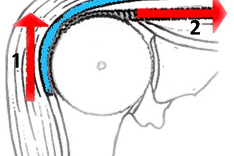 Mit Zeichnungen wie diese erläutert der Mediziner bildlich gängige Erkrankungen am Beispiel des Zusammenspiels der Schultermuskeln beim Anheben des Armes. Der Deltamuskel (1) zieht den Arm nach oben, der Supraspinatusmuskel (2) rollt sich auf dem Oberarmkopf wie auf einer Seilwinde ab und der zwischengelagerte Schleimbeutel (3) dient als Gleitlager